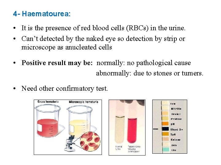 4 - Haematourea: • It is the presence of red blood cells (RBCs) in