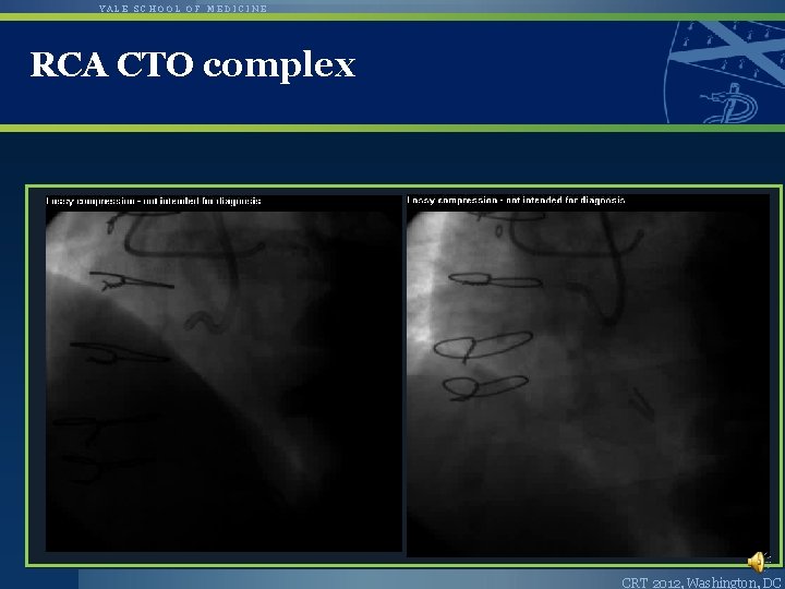 YALE SCHOOL OF MEDICINE RCA CTO complex CRT 2012, Washington, DC 