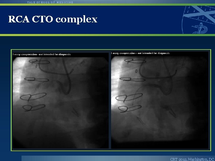 YALE SCHOOL OF MEDICINE RCA CTO complex CRT 2012, Washington, DC 