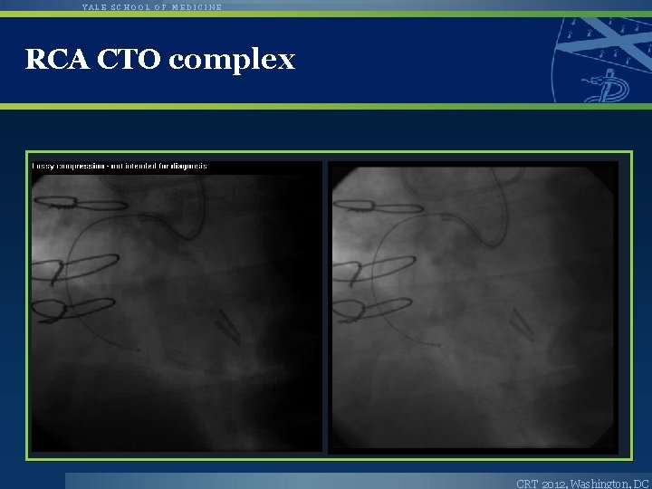 YALE SCHOOL OF MEDICINE RCA CTO complex CRT 2012, Washington, DC 