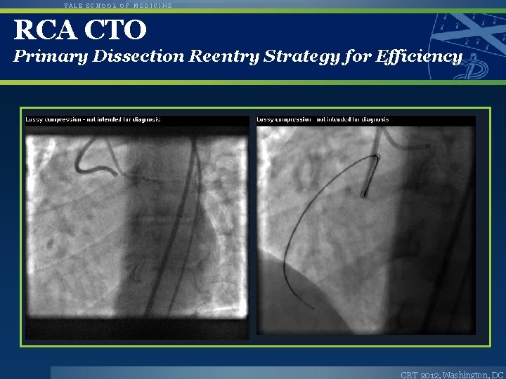 YALE SCHOOL OF MEDICINE RCA CTO Primary Dissection Reentry Strategy for Efficiency CRT 2012, YALE SCHOOL OF MEDICINE RCA CTO Primary Dissection Reentry Strategy for Efficiency CRT 2012,