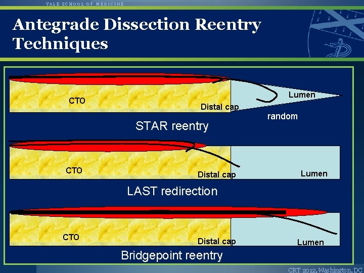 YALE SCHOOL OF MEDICINE Antegrade Dissection Reentry Techniques CTO Lumen Distal cap STAR reentry