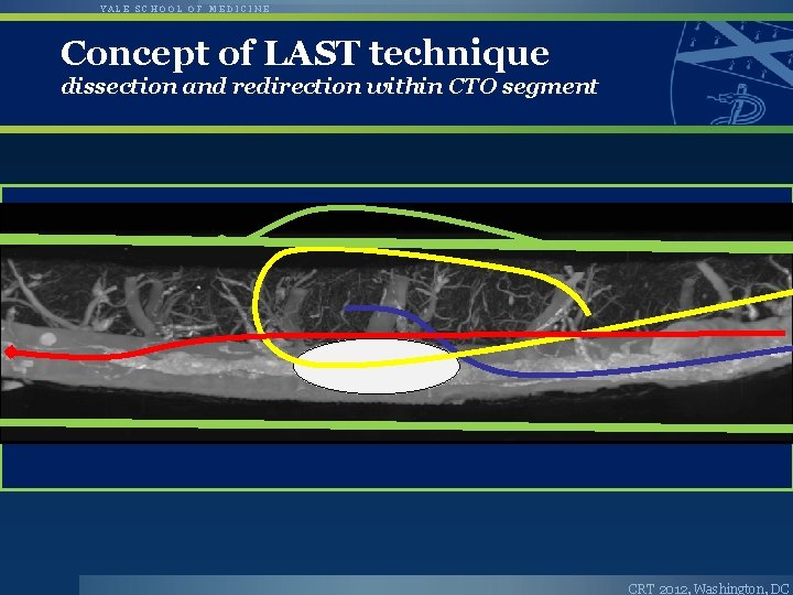YALE SCHOOL OF MEDICINE Concept of LAST technique dissection and redirection within CTO segment