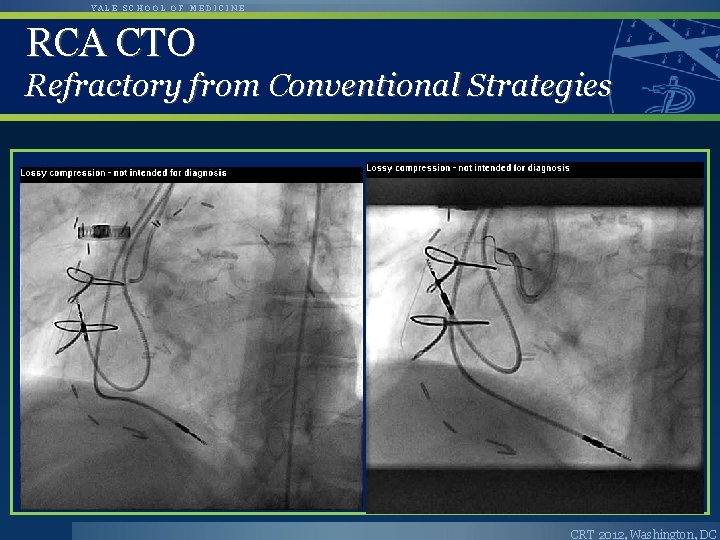 YALE SCHOOL OF MEDICINE RCA CTO Refractory from Conventional Strategies CRT 2012, Washington, DC YALE SCHOOL OF MEDICINE RCA CTO Refractory from Conventional Strategies CRT 2012, Washington, DC