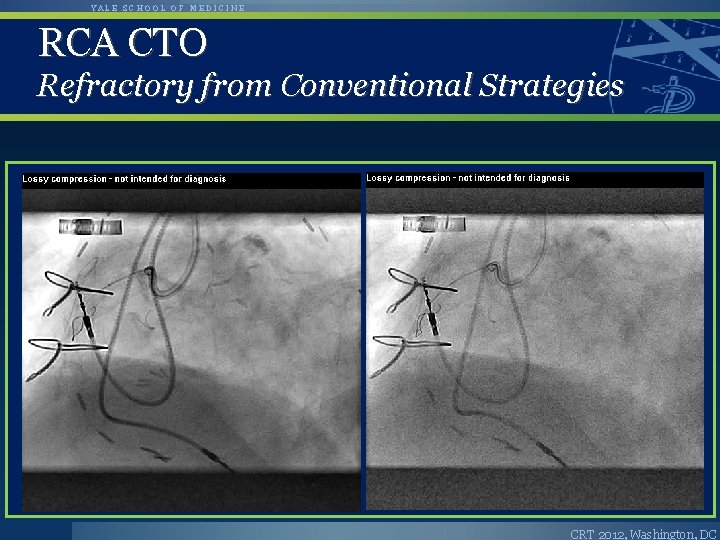 YALE SCHOOL OF MEDICINE RCA CTO Refractory from Conventional Strategies CRT 2012, Washington, DC