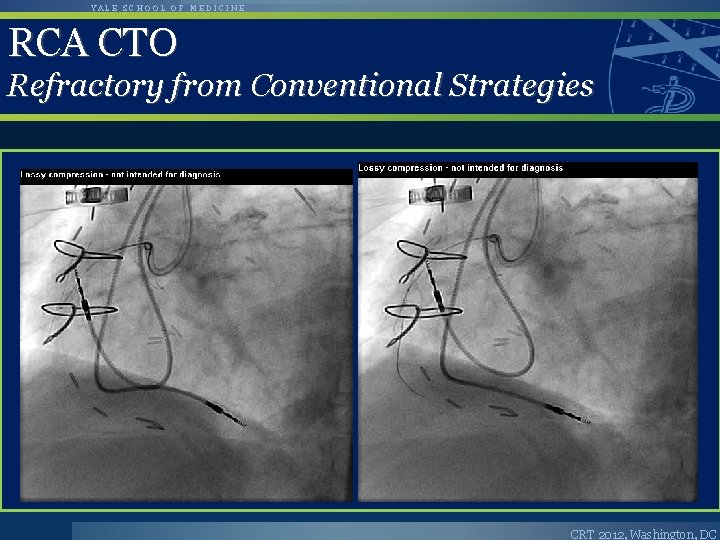 YALE SCHOOL OF MEDICINE RCA CTO Refractory from Conventional Strategies CRT 2012, Washington, DC