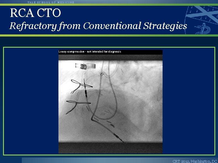 YALE SCHOOL OF MEDICINE RCA CTO Refractory from Conventional Strategies CRT 2012, Washington, DC YALE SCHOOL OF MEDICINE RCA CTO Refractory from Conventional Strategies CRT 2012, Washington, DC