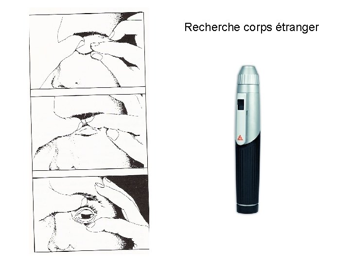 Recherche corps étranger 