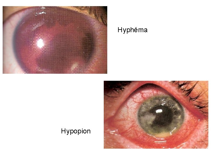 Hyphéma Hypopion 