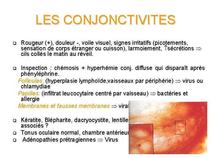 LES CONJONCTIVITES q Rougeur (+), douleur -, voile visuel, signes irritatifs (picotements, sensation de