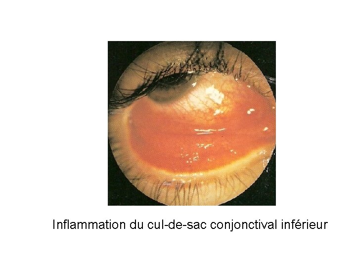 Inflammation du cul-de-sac conjonctival inférieur 