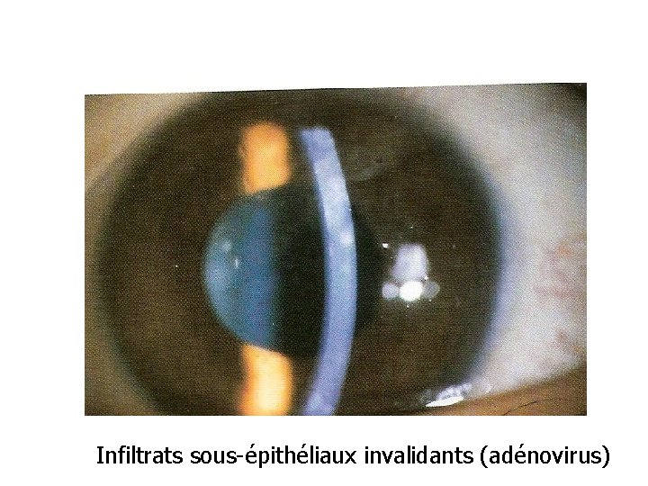 Infiltrats sous-épithéliaux invalidants (adénovirus) 