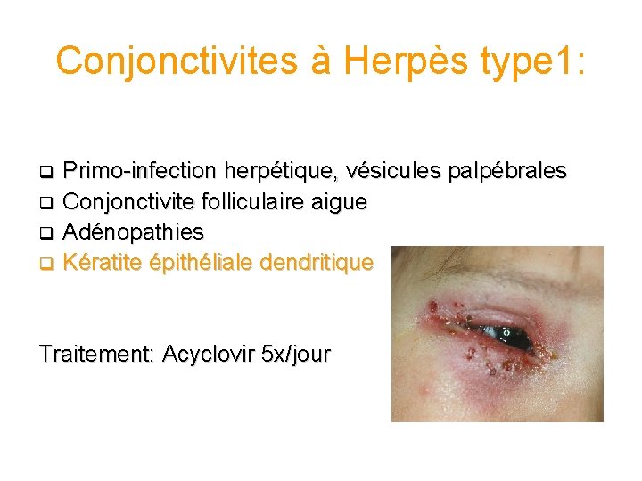 Conjonctivites à Herpès type 1: q q Primo-infection herpétique, vésicules palpébrales Conjonctivite folliculaire aigue