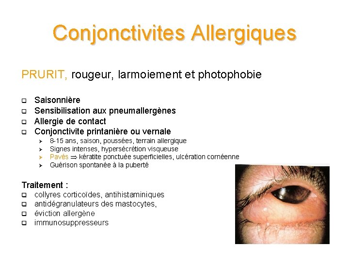 Conjonctivites Allergiques PRURIT, rougeur, larmoiement et photophobie q q Saisonnière Sensibilisation aux pneumallergènes Allergie