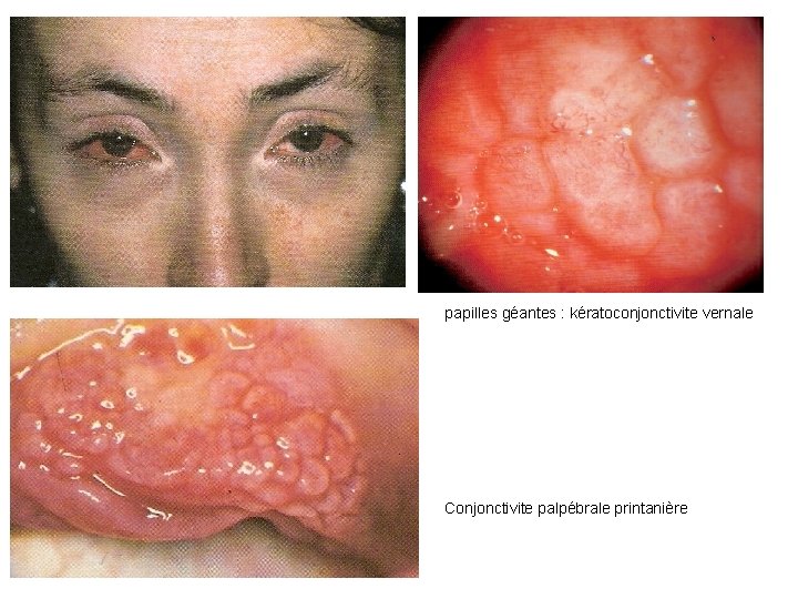 papilles géantes : kératoconjonctivite vernale Conjonctivite palpébrale printanière 