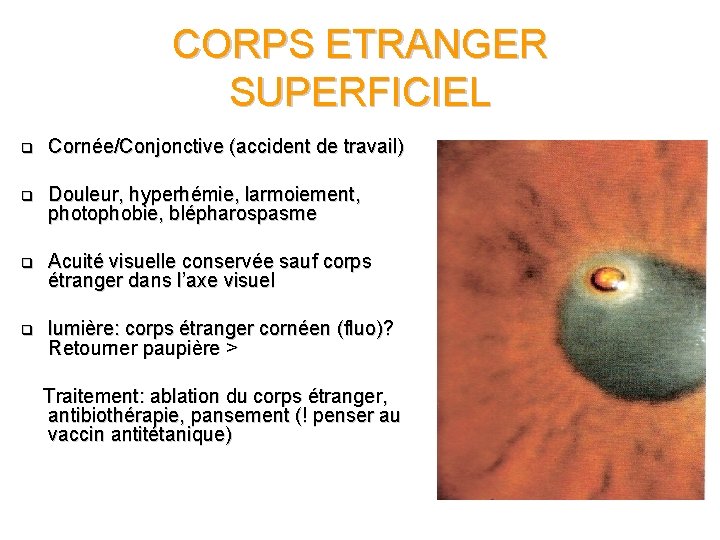 CORPS ETRANGER SUPERFICIEL q Cornée/Conjonctive (accident de travail) q Douleur, hyperhémie, larmoiement, photophobie, blépharospasme