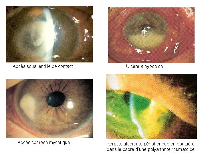 Abcès sous lentille de contact Abcès cornéen mycotique Ulcère à hypopion Kératite ulcérante périphérique