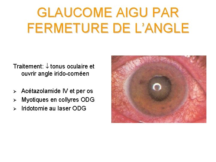 GLAUCOME AIGU PAR FERMETURE DE L’ANGLE Traitement: tonus oculaire et ouvrir angle irido-cornéen Ø