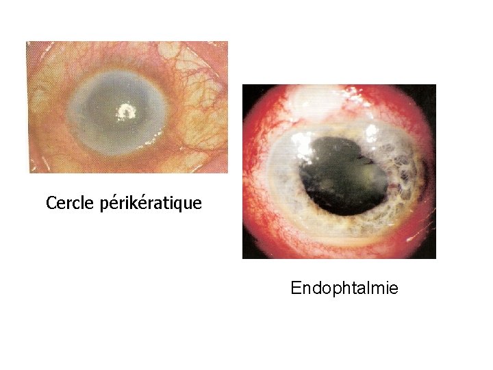 Cercle périkératique Endophtalmie 