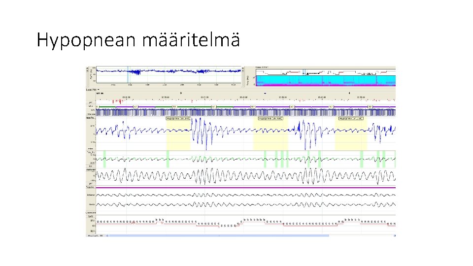 Hypopnean määritelmä 