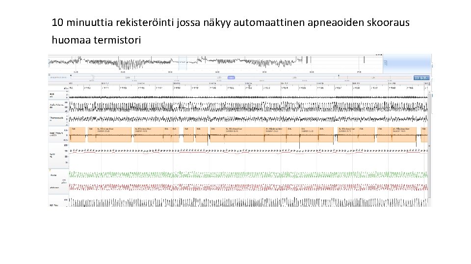 10 minuuttia rekisteröinti jossa näkyy automaattinen apneaoiden skooraus huomaa termistori 