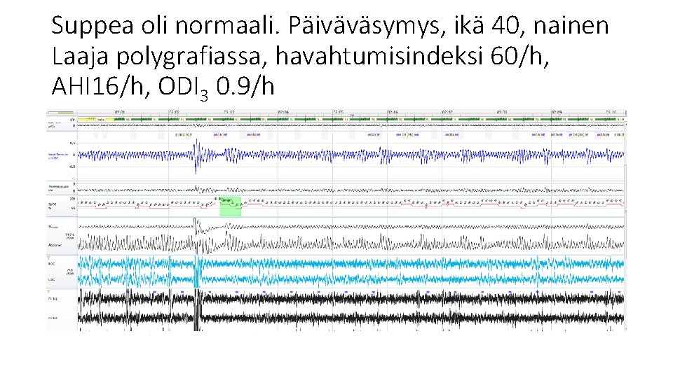 Suppea oli normaali. Päiväväsymys, ikä 40, nainen Laaja polygrafiassa, havahtumisindeksi 60/h, AHI 16/h, ODI