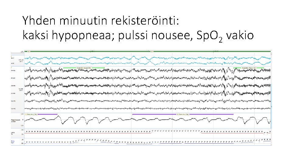 Yhden minuutin rekisteröinti: kaksi hypopneaa; pulssi nousee, Sp. O 2 vakio 
