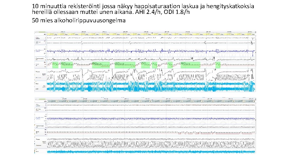 10 minuuttia rekisteröinti jossa näkyy happisaturaation laskua ja hengityskatkoksia hereillä ollessaan muttei unen aikana.