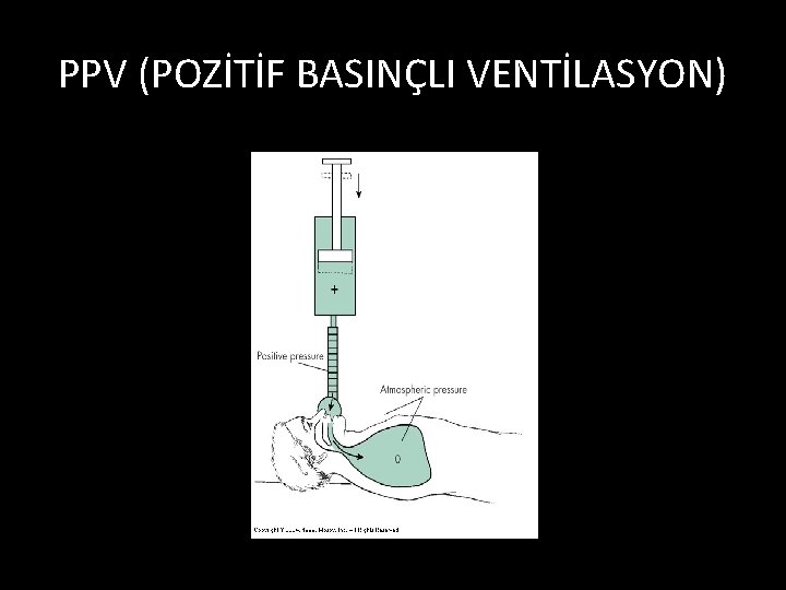 PPV (POZİTİF BASINÇLI VENTİLASYON) 