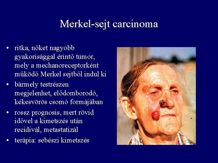 Merkel-sejt carcinoma • ritka, nőket nagyobb gyakorisággal érintő tumor, mely a mechanoreceptorként működő Merkel Merkel-sejt carcinoma • ritka, nőket nagyobb gyakorisággal érintő tumor, mely a mechanoreceptorként működő Merkel