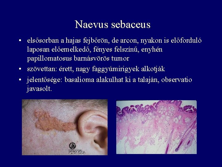 Naevus sebaceus • elsősorban a hajas fejbőrön, de arcon, nyakon is előforduló laposan előemelkedő,