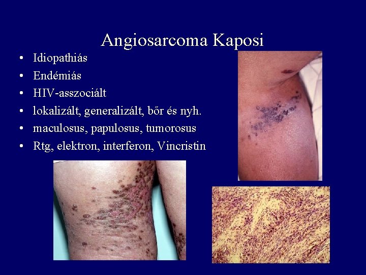 Angiosarcoma Kaposi • • • Idiopathiás Endémiás HIV-asszociált lokalizált, generalizált, bőr és nyh. maculosus,