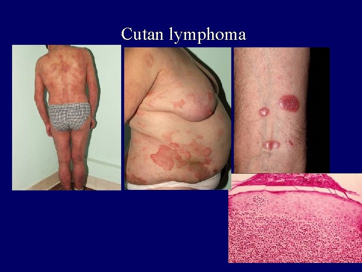 Cutan lymphoma Cutan lymphoma