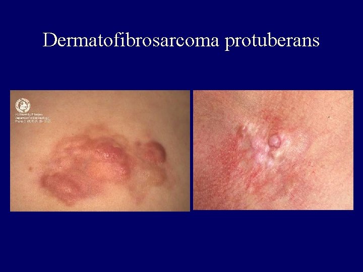 Dermatofibrosarcoma protuberans Dermatofibrosarcoma protuberans