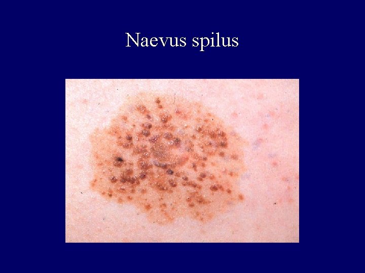 Naevus spilus Naevus spilus