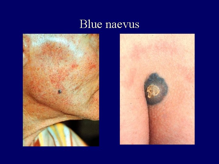 Blue naevus Blue naevus