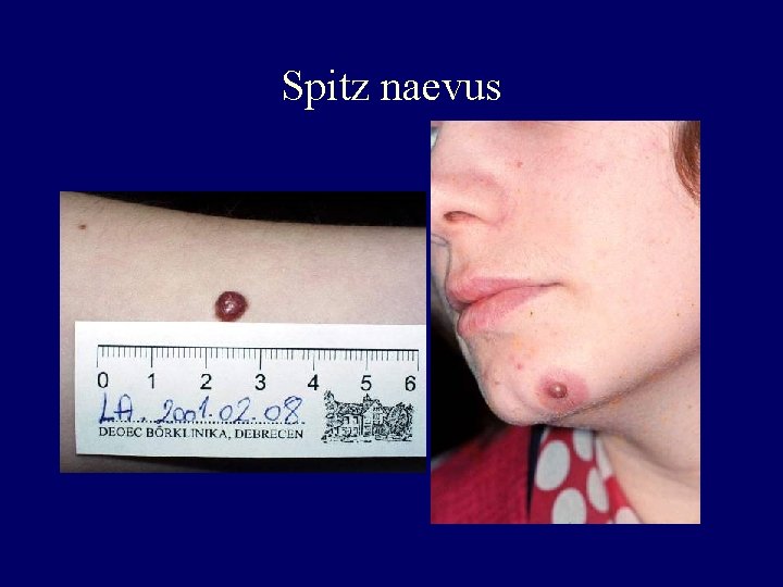 Spitz naevus Spitz naevus