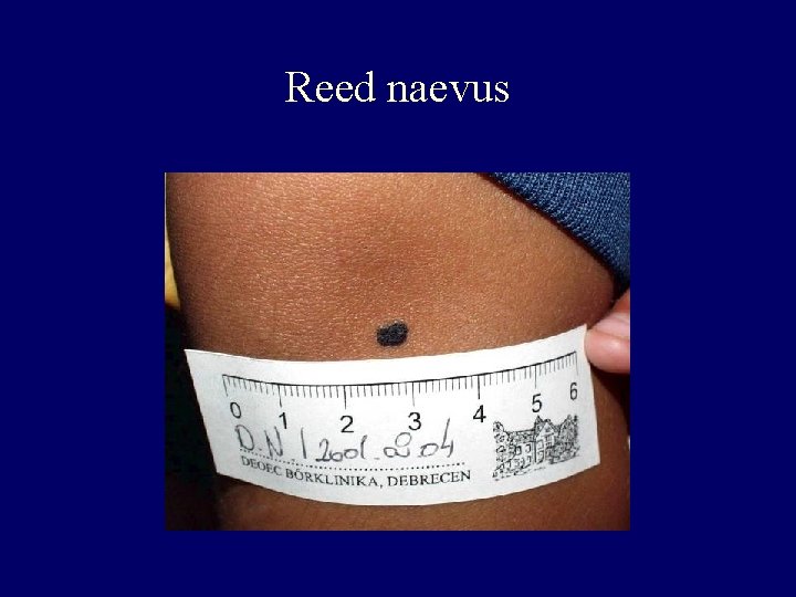 Reed naevus Reed naevus