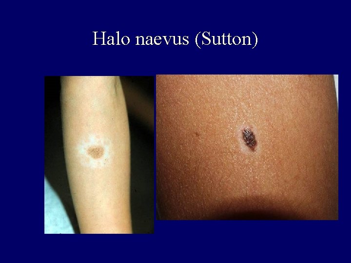 Halo naevus (Sutton) Halo naevus (Sutton)
