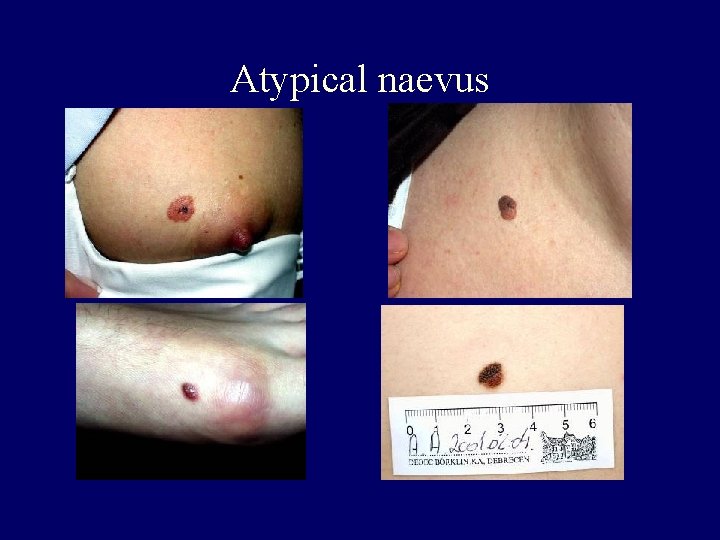 Atypical naevus 