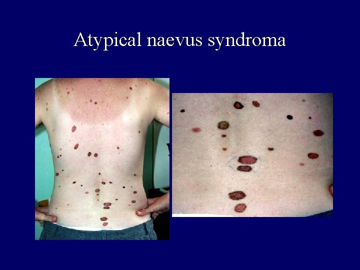 Atypical naevus syndroma Atypical naevus syndroma