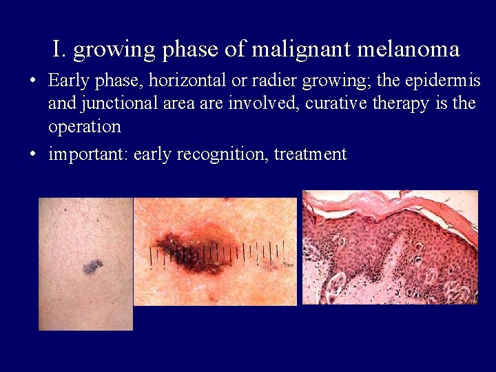 I. growing phase of malignant melanoma • Early phase, horizontal or radier growing; the I. growing phase of malignant melanoma • Early phase, horizontal or radier growing; the