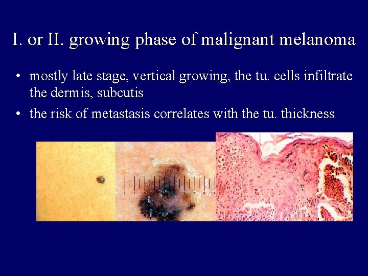 I. or II. growing phase of malignant melanoma • mostly late stage, vertical growing, I. or II. growing phase of malignant melanoma • mostly late stage, vertical growing,