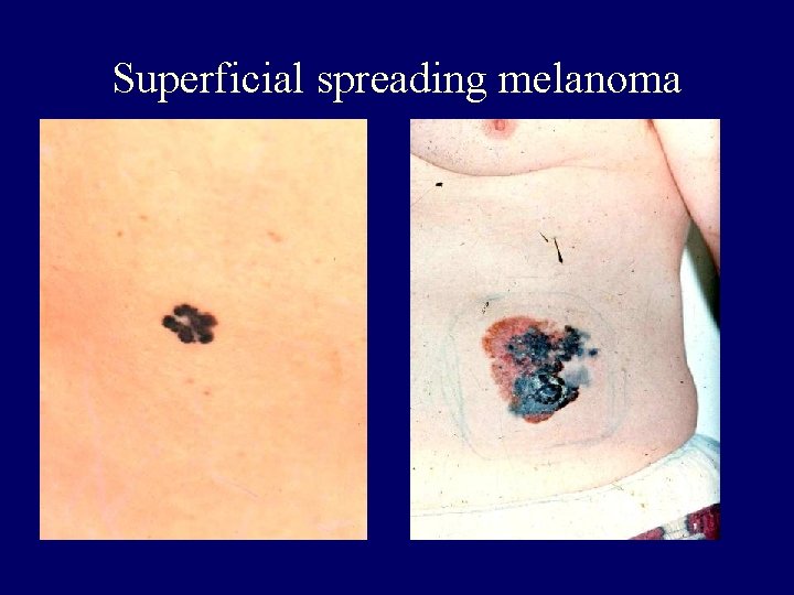 Superficial spreading melanoma Superficial spreading melanoma