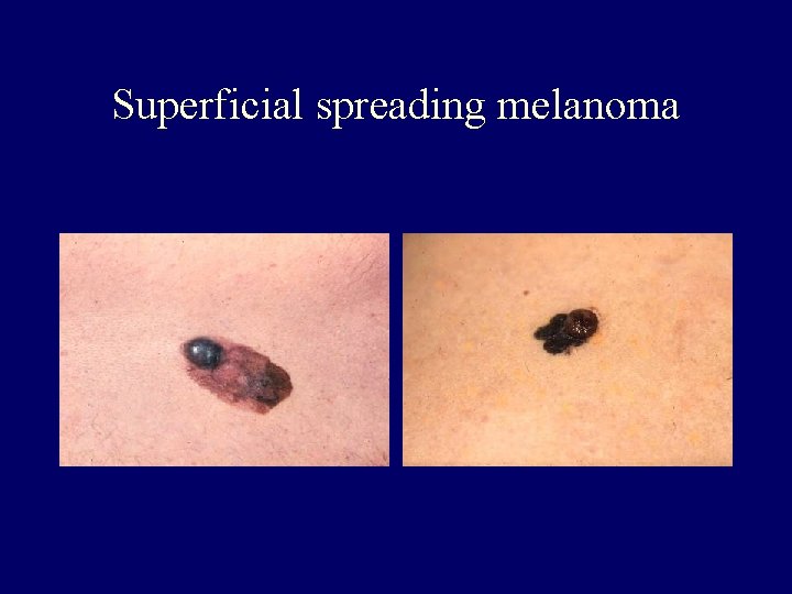 Superficial spreading melanoma Superficial spreading melanoma