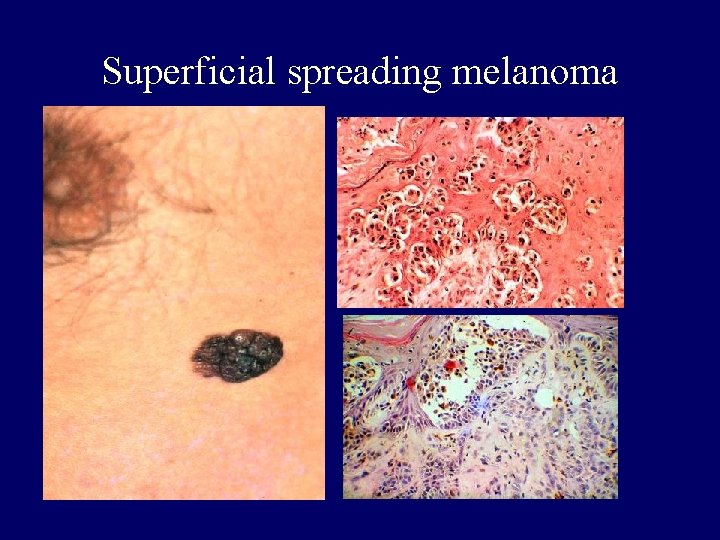 Superficial spreading melanoma Superficial spreading melanoma