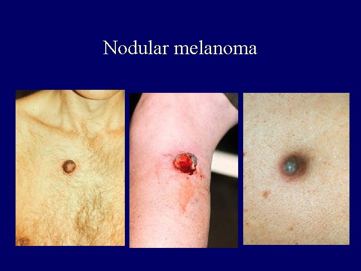 Nodular melanoma 
