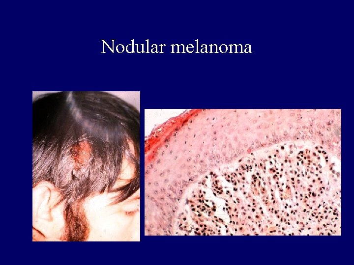 Nodular melanoma 
