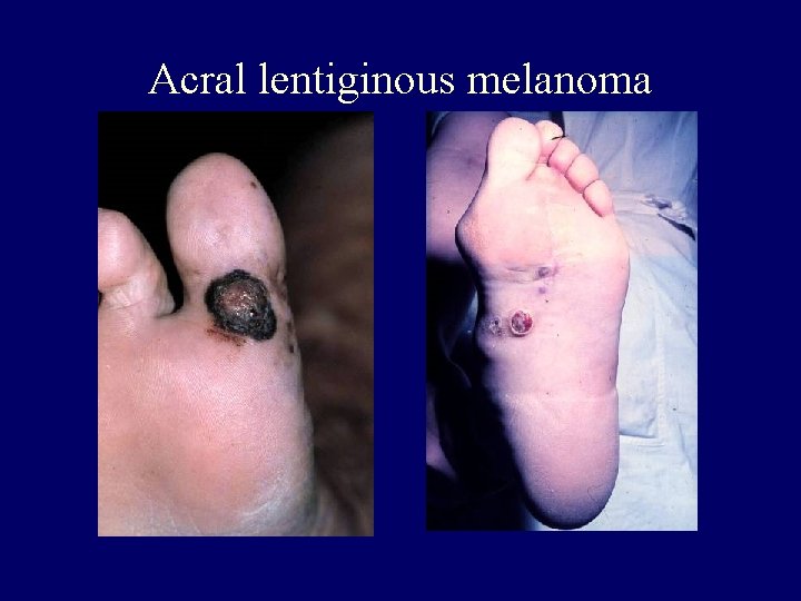 Acral lentiginous melanoma Acral lentiginous melanoma