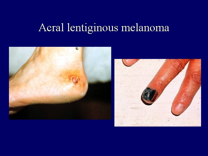 Acral lentiginous melanoma Acral lentiginous melanoma
